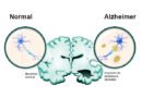 Nova terapia freia avanço do Alzheimer